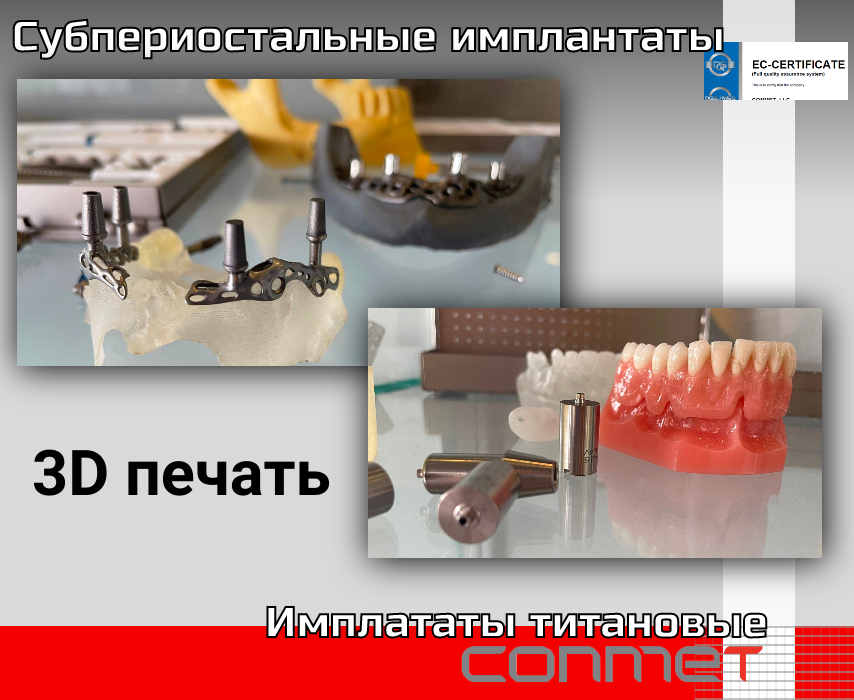 Субпериостальные имплантаты КОНМЕТ на 3D печать